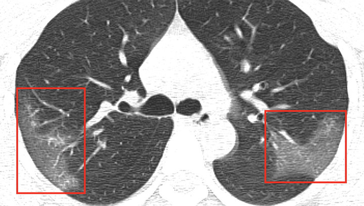 Медики показали легкие, зараженные коронавирусом 2019-nСоV