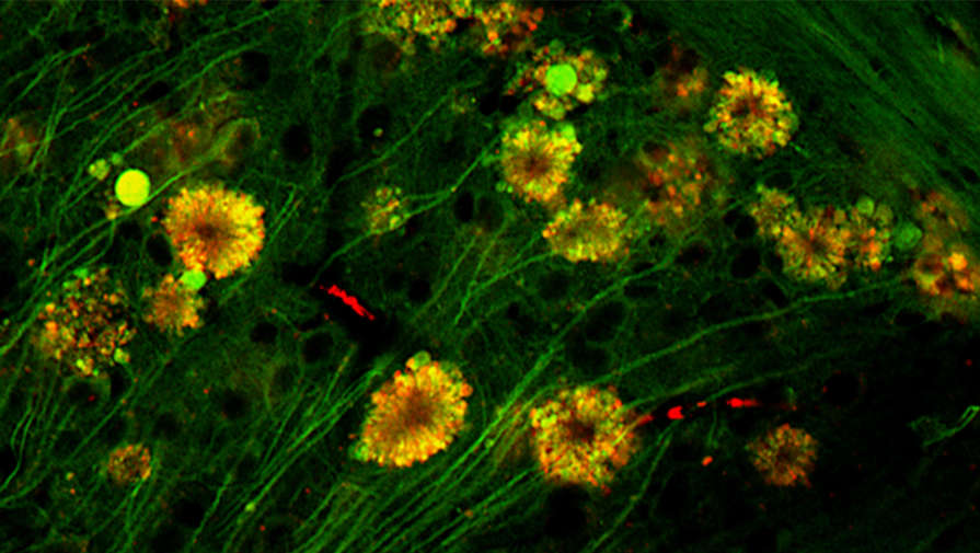 Нейробиологи предложили новую причину развития болезни Альцгеймера