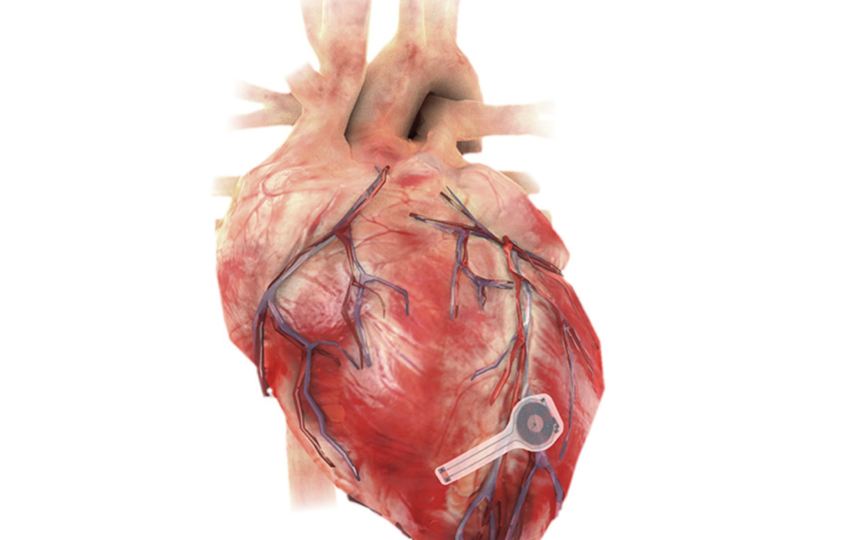 Кардиостимулятор растворится, когда будет больше не нужен хозяину