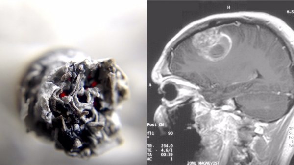 Ученые открыли свойство никотина помогать раку попасть в мозг